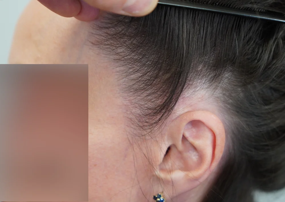 After hair restoration: Female patient underwent FUE procedure of 607 grafts.