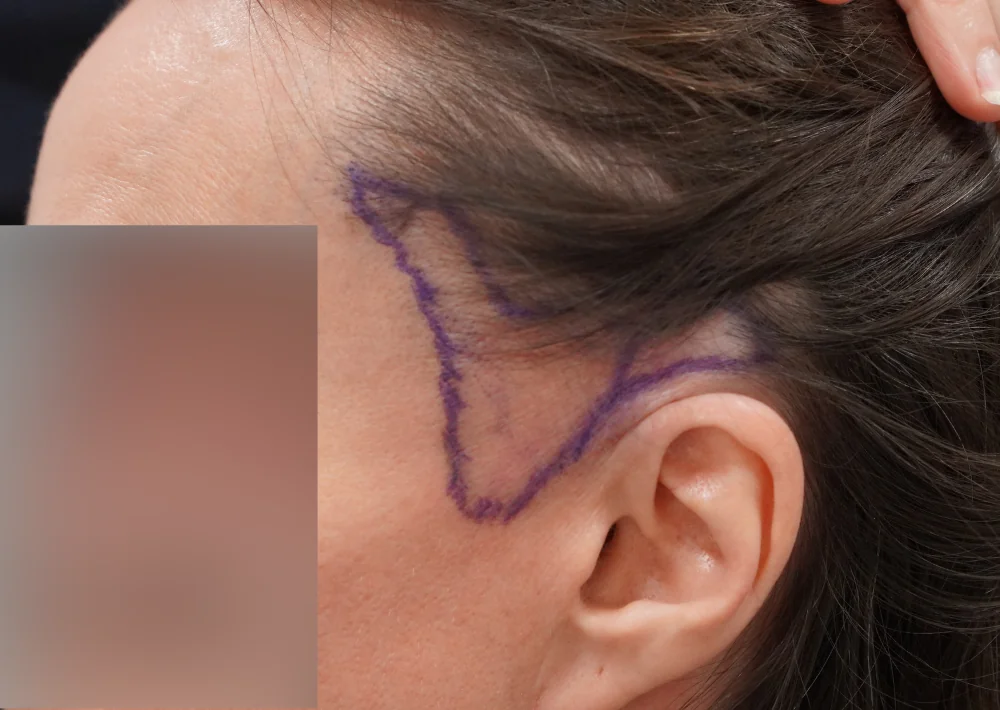 Before hair restoration: Female patient underwent FUE procedure of 607 grafts.