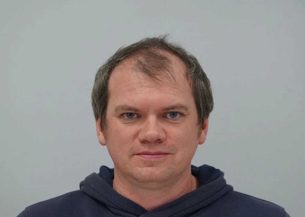 Before hair restoration: Male patient underwent FUT procedure of 3535 grafts.