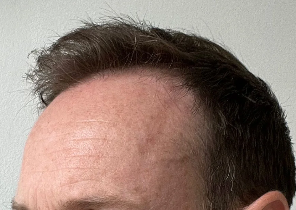After hair restoration: Male patient underwent FUE procedure of 991 grafts.