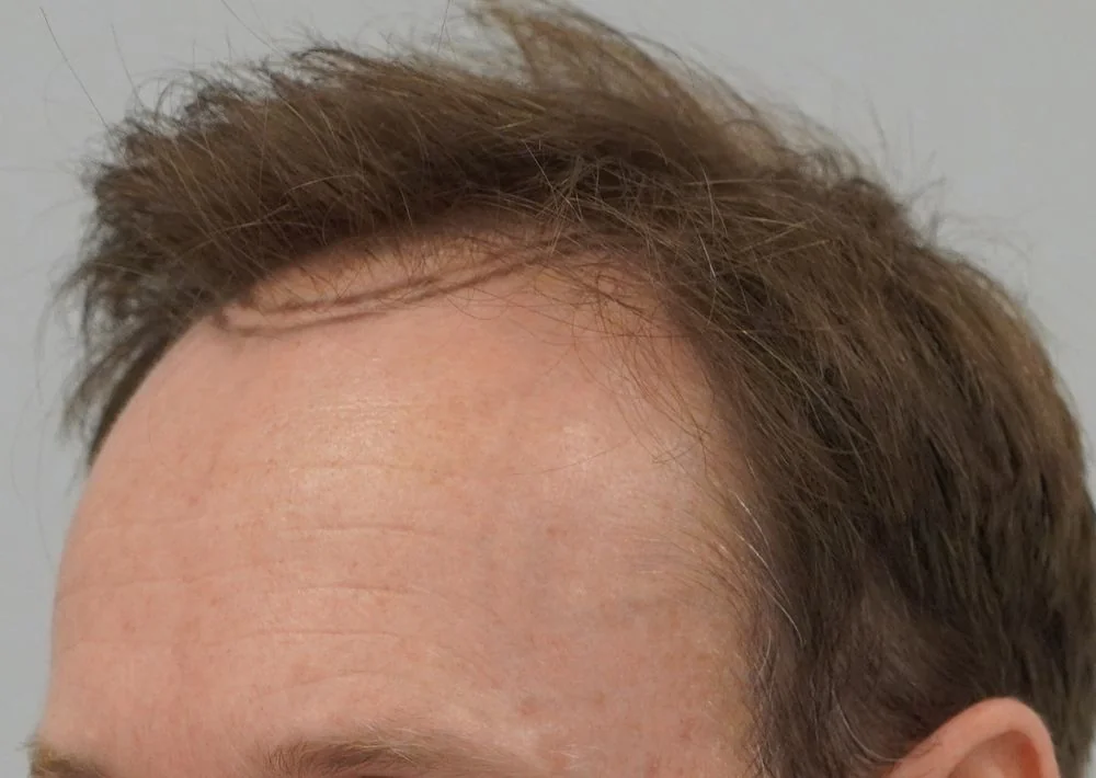 Before hair restoration: Male patient underwent FUE procedure of 991 grafts.