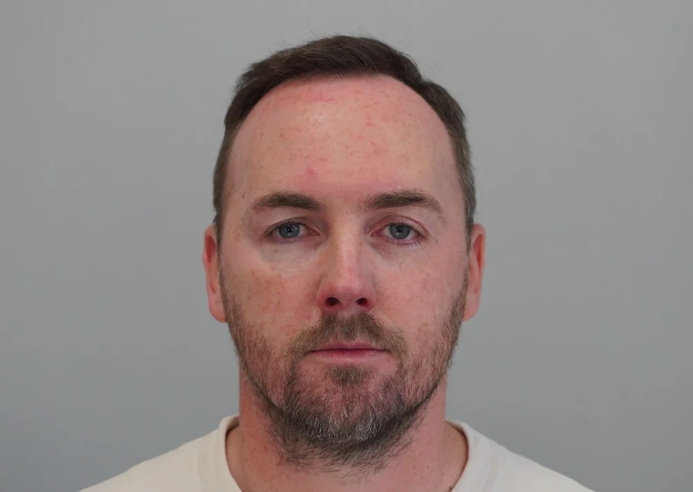 After hair restoration: Male patient underwent FUE procedure of 2400 grafts.