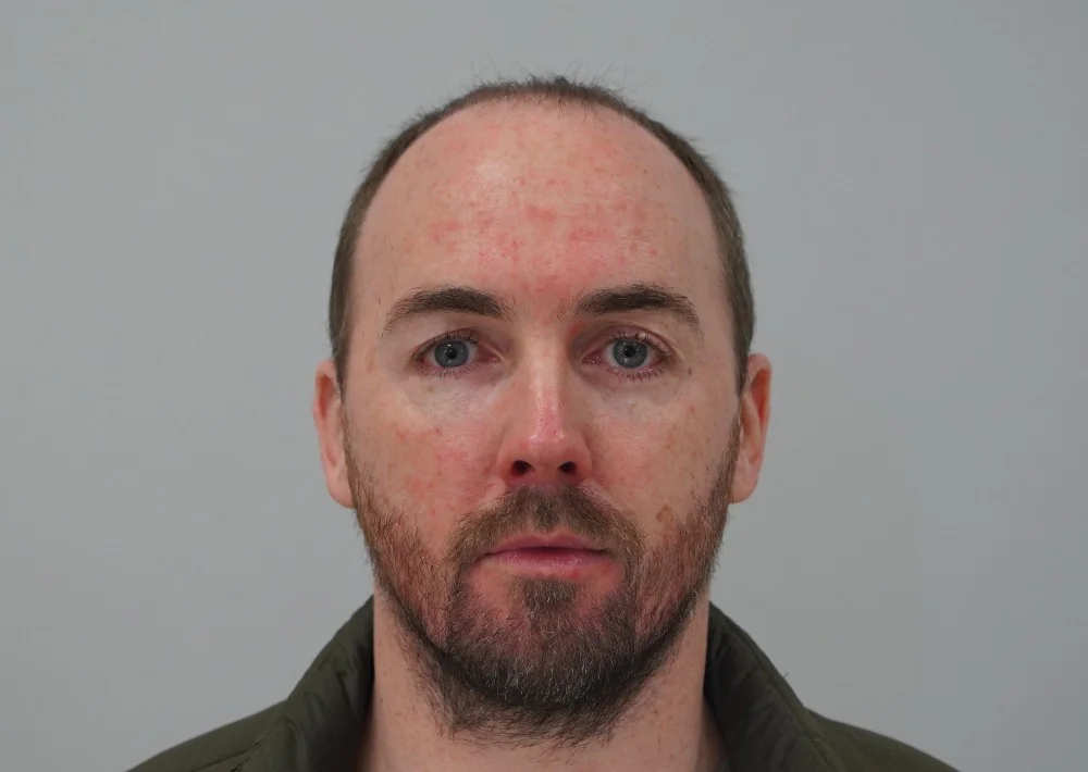 Before hair restoration: Male patient underwent FUE procedure of 2400 grafts.