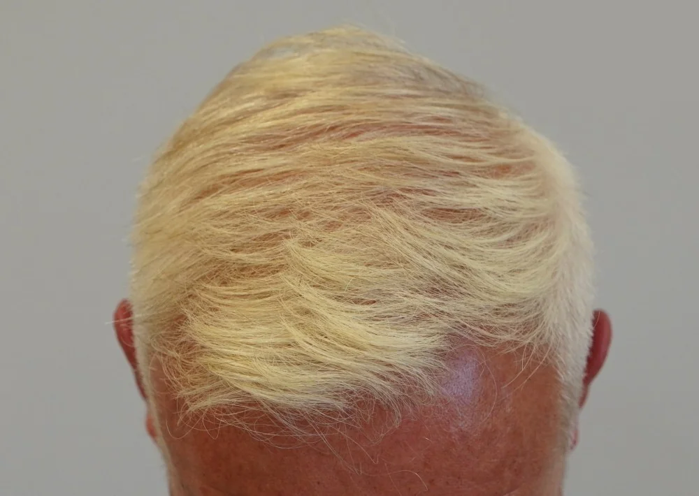 After hair restoration: Male patient underwent FUE procedure of 2280 grafts.