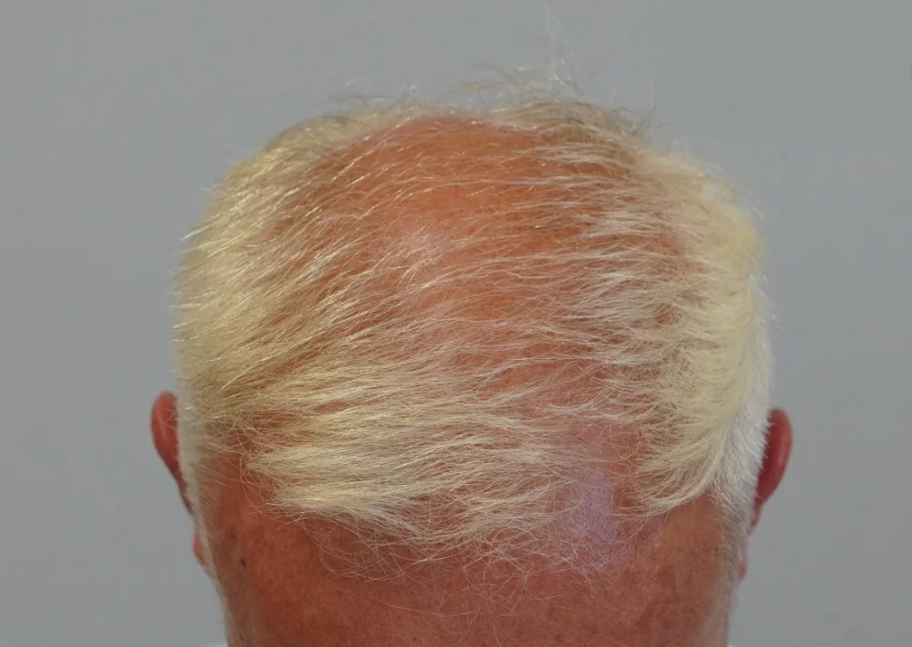 Before hair restoration: Male patient underwent FUE procedure of 2280 grafts.