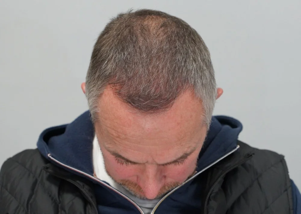 After hair restoration: Male patient underwent FUE procedure of 1725 grafts.