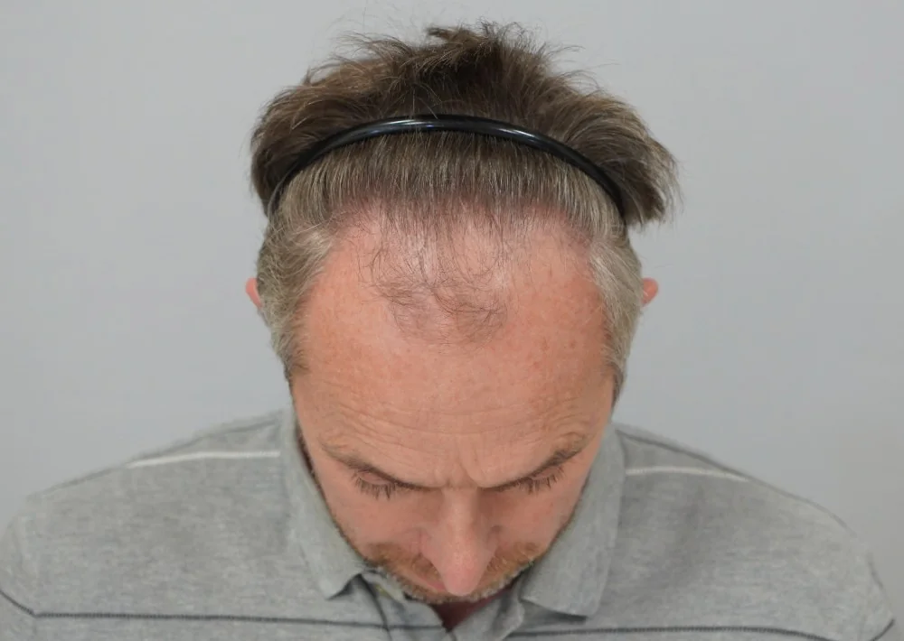 Before hair restoration: Male patient underwent FUE procedure of 1725 grafts.