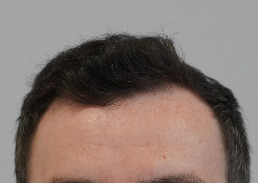 After hair restoration: Male patient underwent FUE procedure of 2083 grafts.