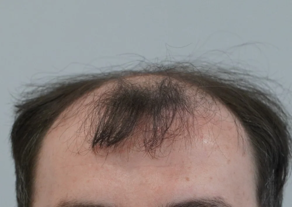 Before hair restoration: Male patient underwent FUE procedure of 2083 grafts.