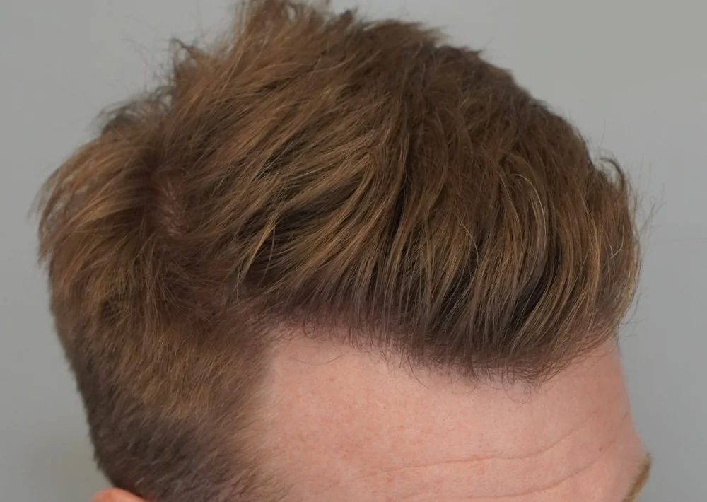After hair restoration: Male patient underwent FUE procedure of 1204 grafts.