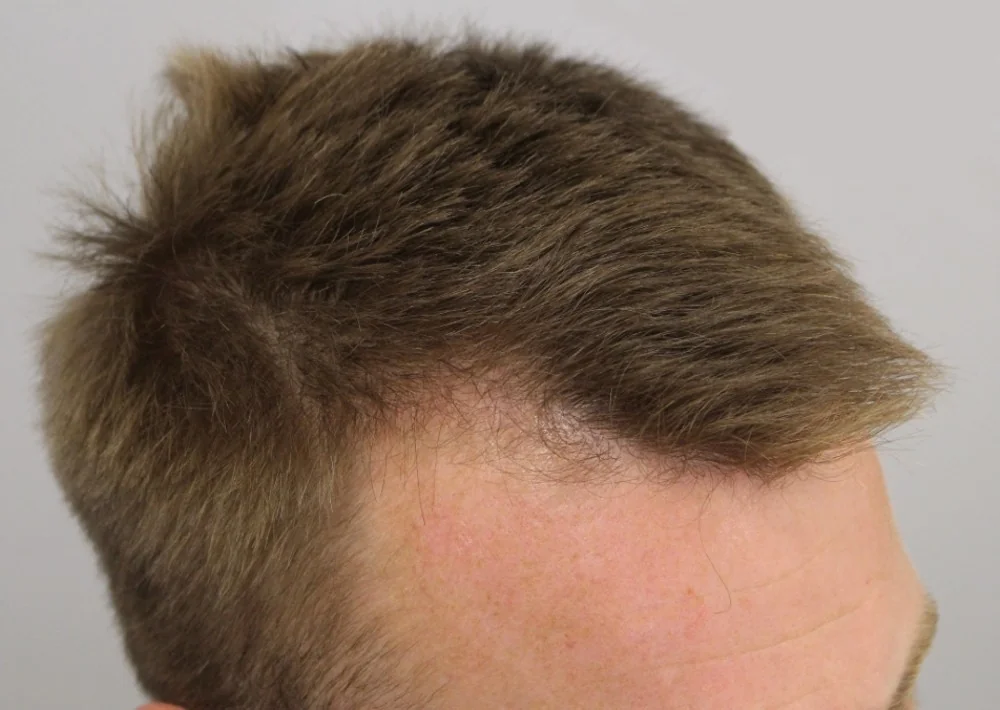 Before hair restoration: Male patient underwent FUE procedure of 1204 grafts.