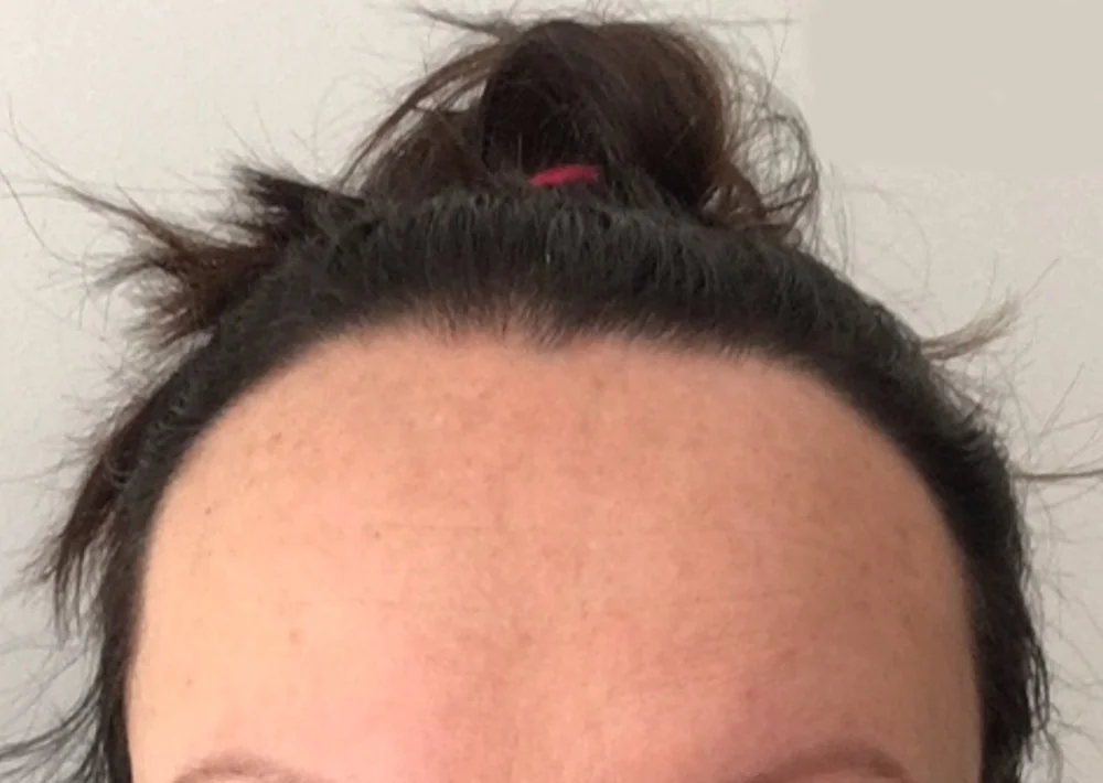 After hair restoration: Female patient underwent FUT procedure of 1617 grafts.