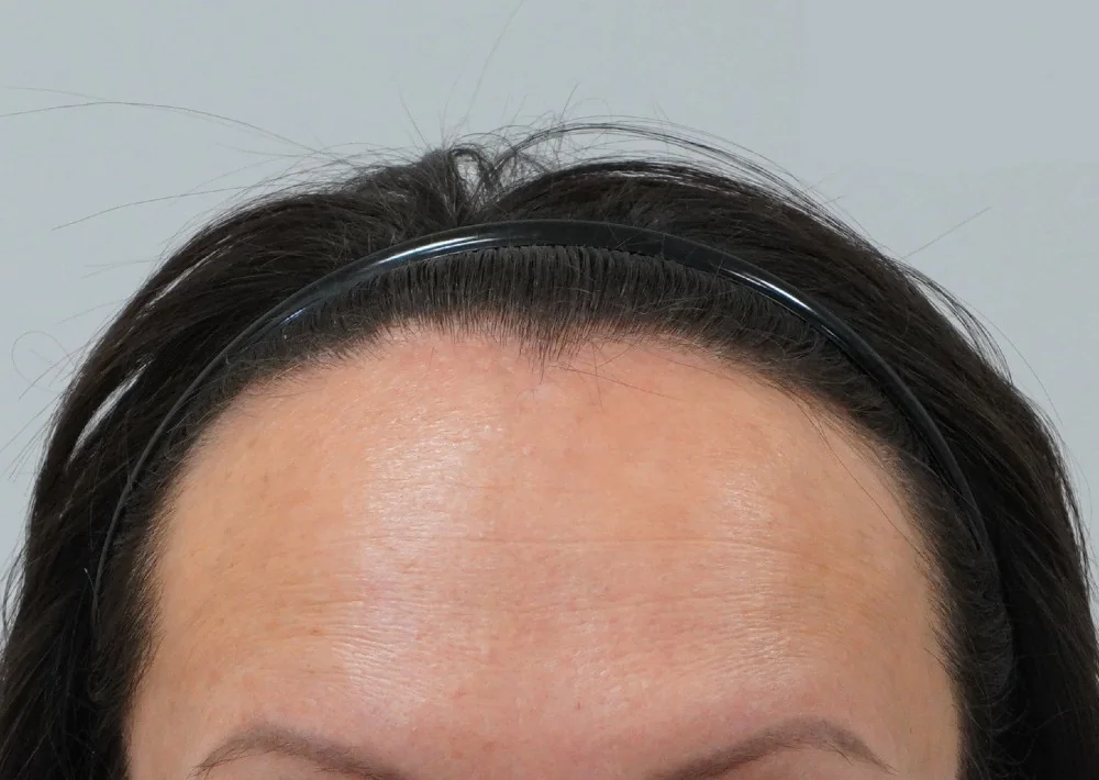 Before hair restoration: Female patient underwent FUT procedure of 1617 grafts.