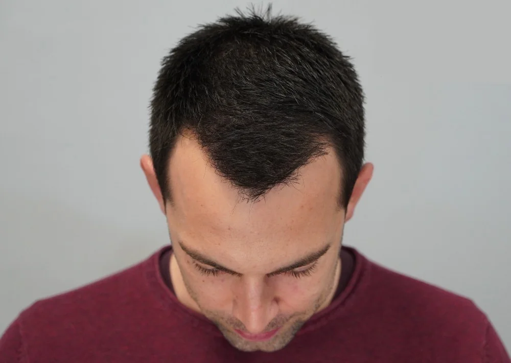 After hair restoration: Male patient underwent FUE procedure of 1420 grafts.