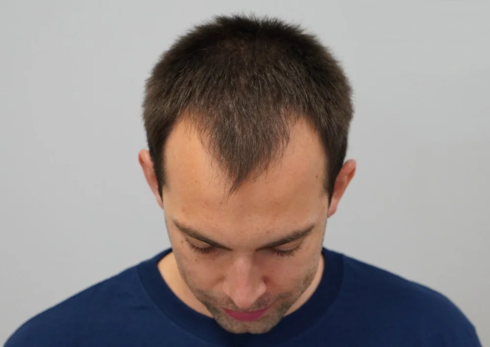 Before hair restoration: Male patient underwent FUE procedure of 1420 grafts.