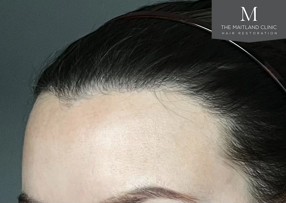 After hair restoration: Female patient underwent FUT procedure of 1005 grafts.