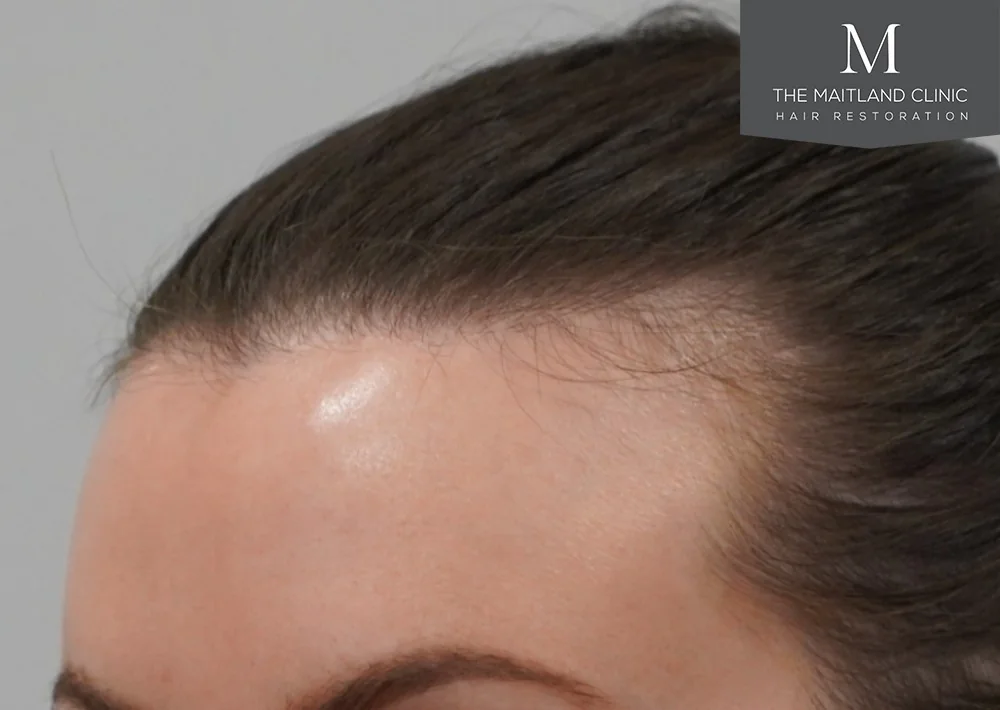 Before hair restoration: Female patient underwent FUT procedure of 1005 grafts.