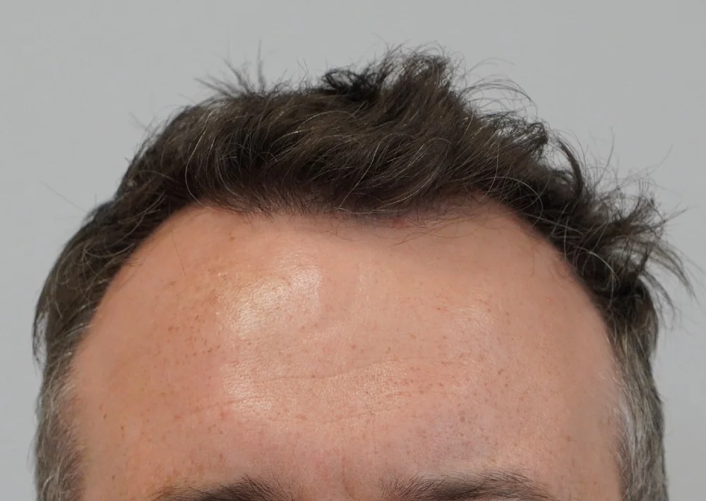 After hair restoration: Male patient underwent FUE procedure of 1792 grafts.