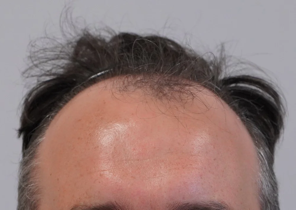 Before hair restoration: Male patient underwent FUE procedure of 1792 grafts.