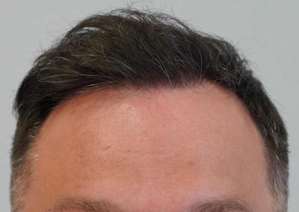 After hair restoration: Male patient underwent FUE procedure of 2058 grafts.