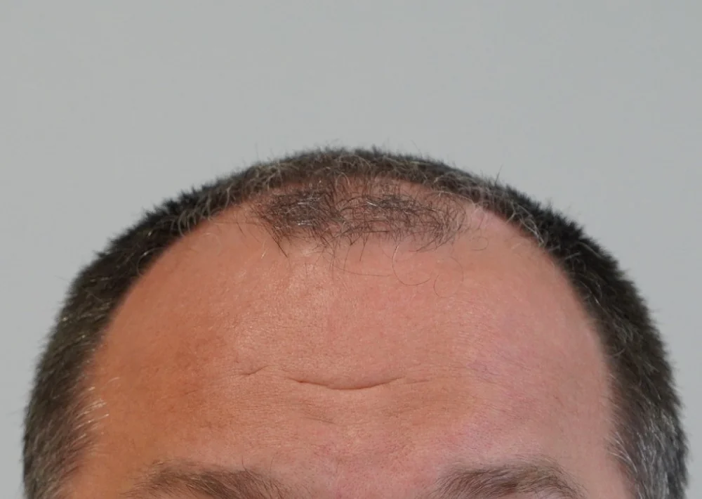 Before hair restoration: Male patient underwent FUE procedure of 2058 grafts.