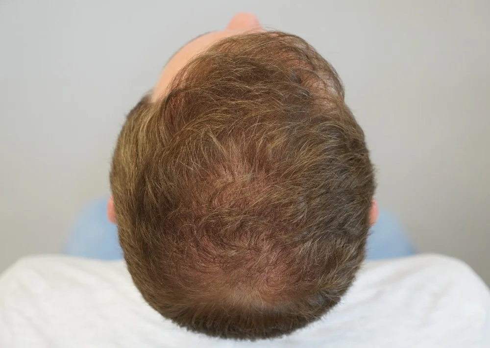 After hair restoration: Male patient underwent FUT procedure of 2320 grafts.