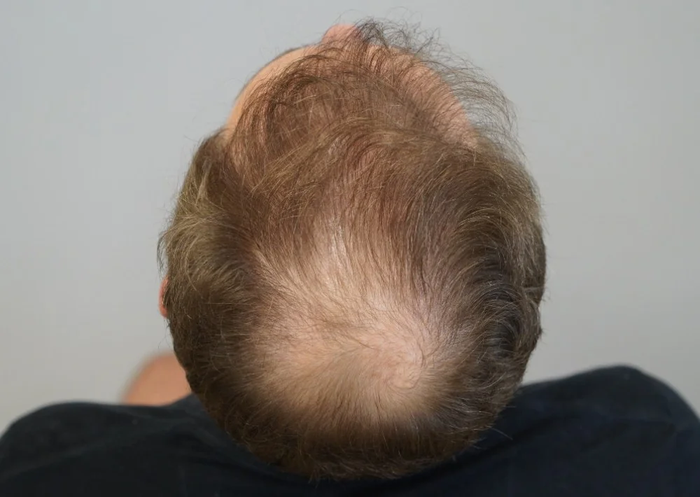 Before hair restoration: Male patient underwent FUT procedure of 2320 grafts.