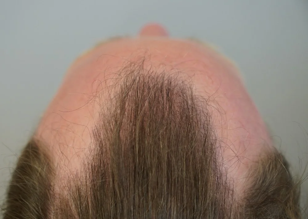 After hair restoration: Male patient underwent FUE procedure of 2076 grafts.