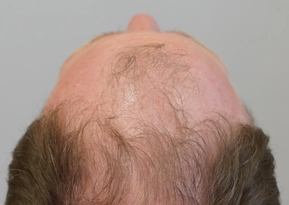Before hair restoration: Male patient underwent FUE procedure of 2076 grafts.