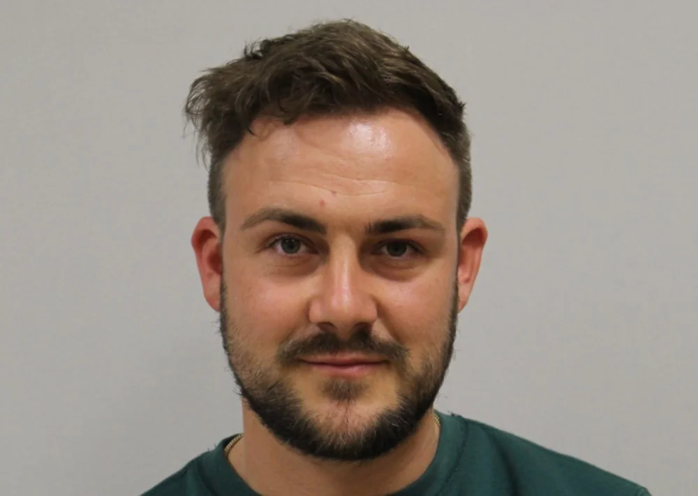 After hair restoration: Male patient underwent FUE procedure of 1844 grafts.