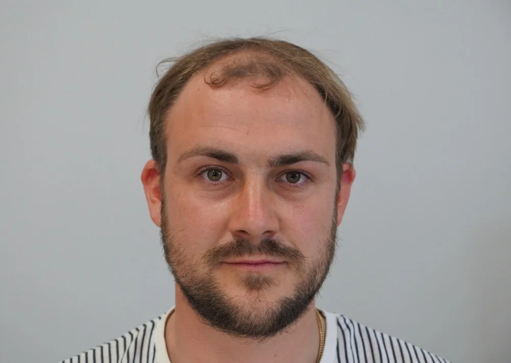 Before hair restoration: Male patient underwent FUE procedure of 1844 grafts.