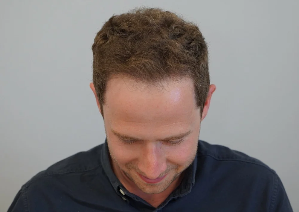 After hair restoration: Male patient underwent FUE procedure of 2026 grafts.