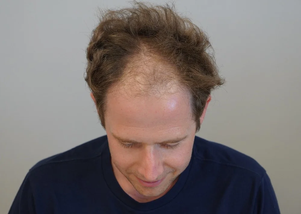 Before hair restoration: Male patient underwent FUE procedure of 2026 grafts.