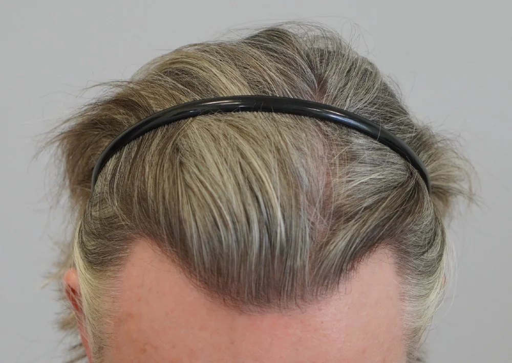 After hair restoration: Male patient underwent FUT procedure of 1895 grafts.