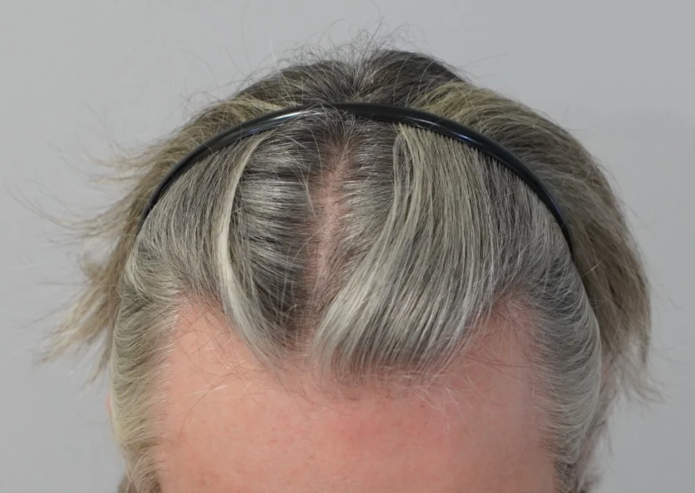 Before hair restoration: Male patient underwent FUT procedure of 1895 grafts.