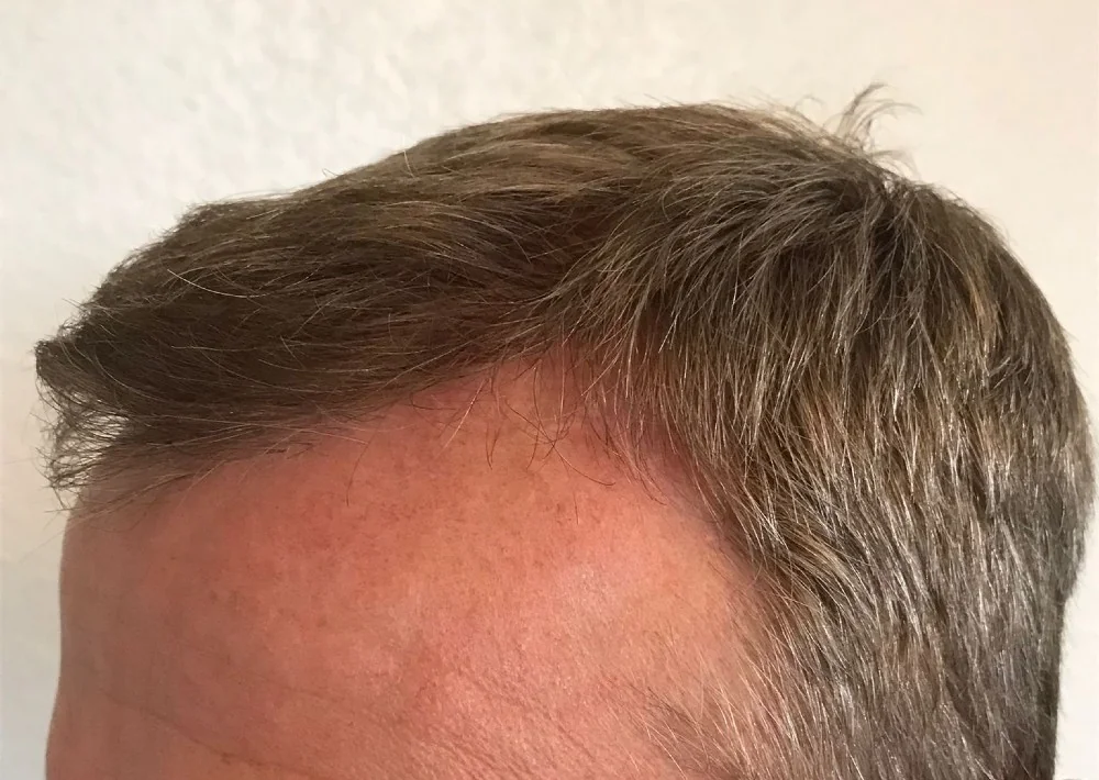 After hair restoration: Male patient underwent FUT procedure of 3,589 grafts for hairline and crown.