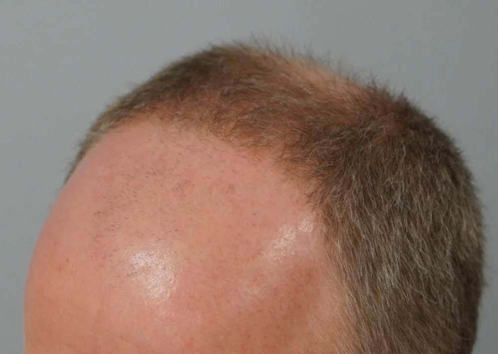 Before hair restoration: Male patient underwent FUT procedure of 3,589 grafts for hairline and crown.