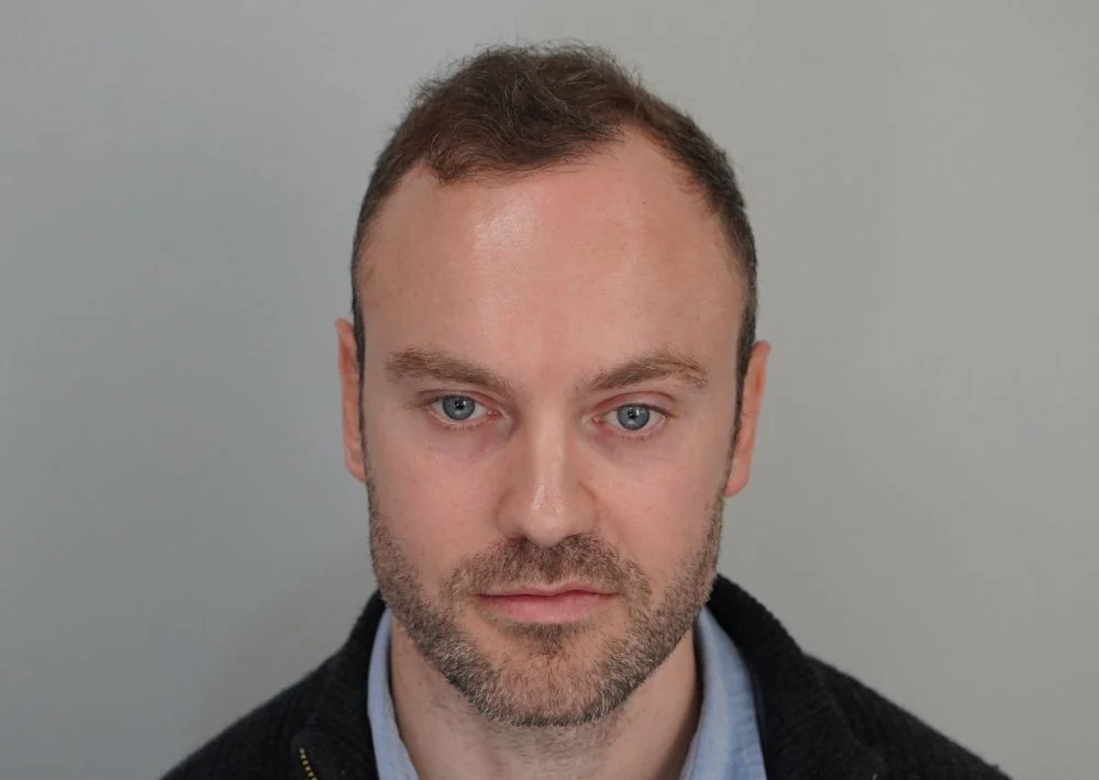 After hair restoration: Male patient underwent FUE procedure of 3661 grafts.