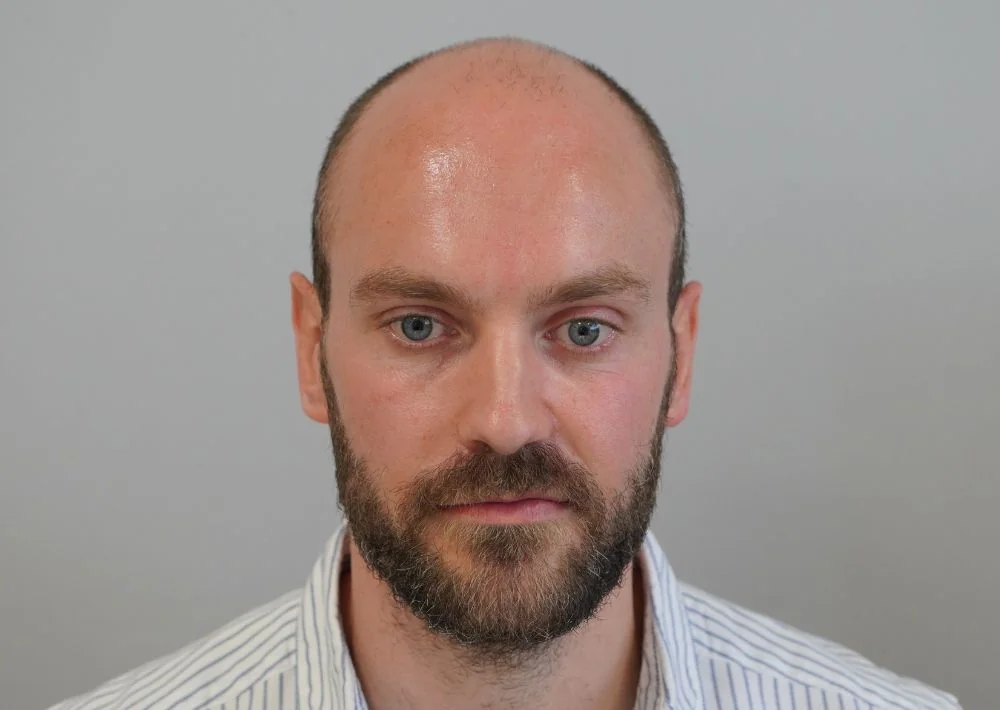 Before hair restoration: Male patient underwent FUE procedure of 3661 grafts.