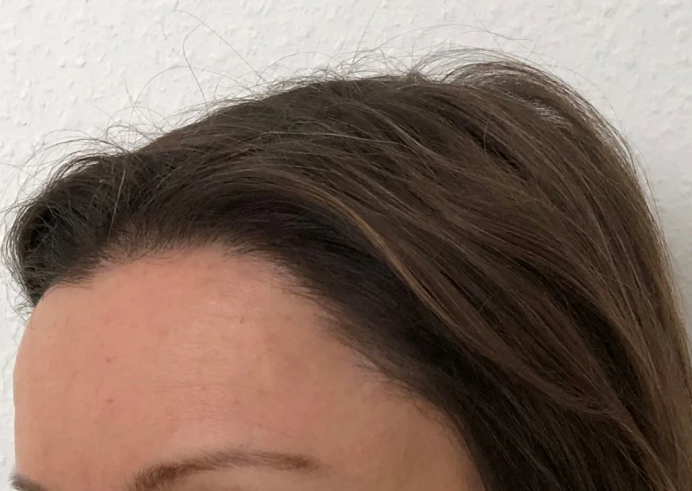 After hair restoration: Female patient underwent FUT procedure of 4171 grafts.