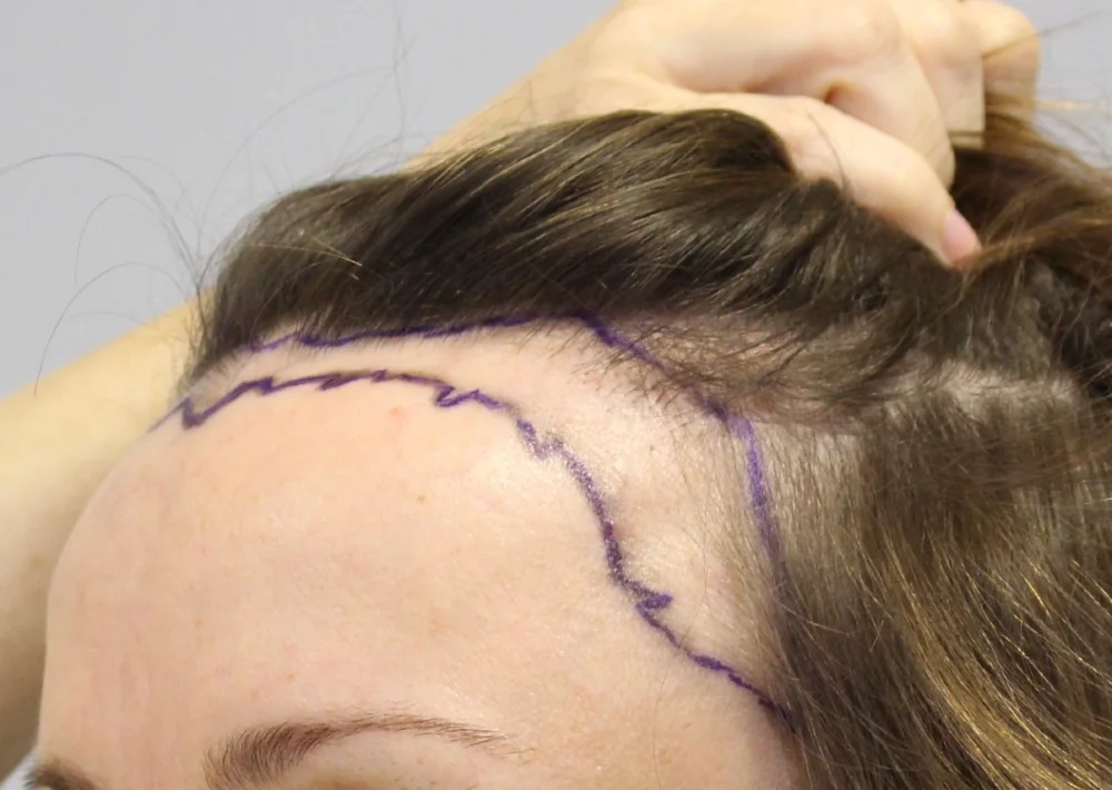 Before hair restoration: Female patient underwent FUT procedure of 4171 grafts.