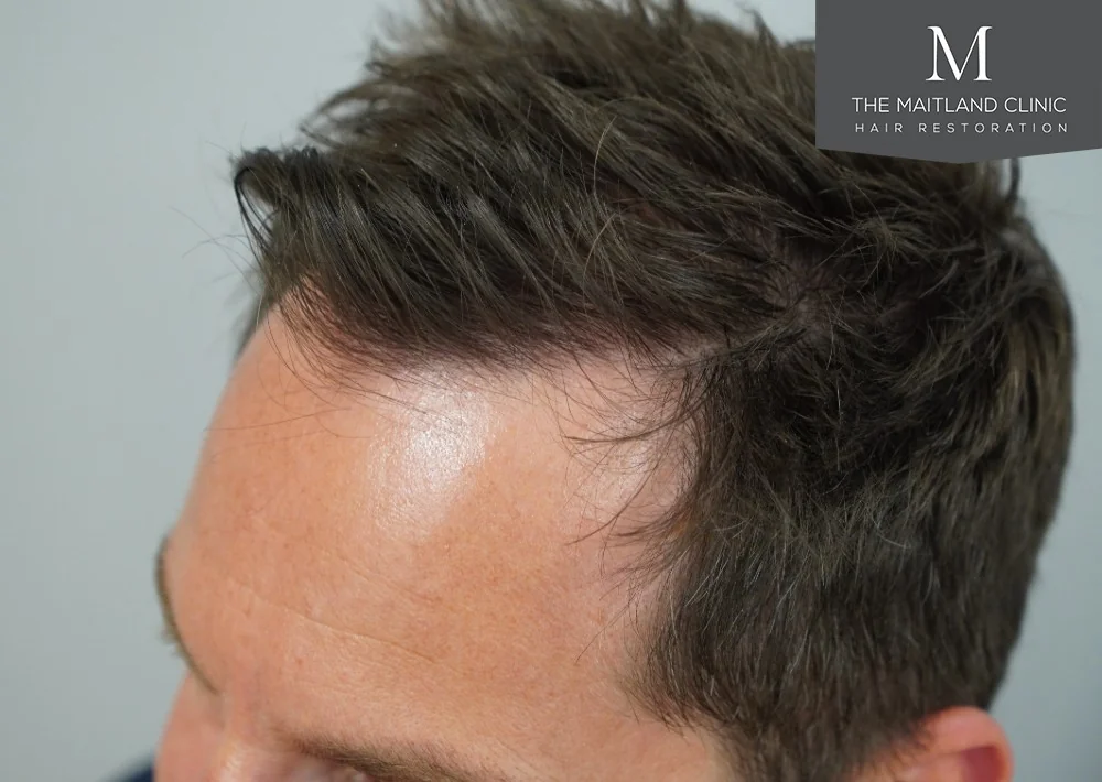 After hair restoration: Male patient underwent FUE procedure of 1675 grafts.