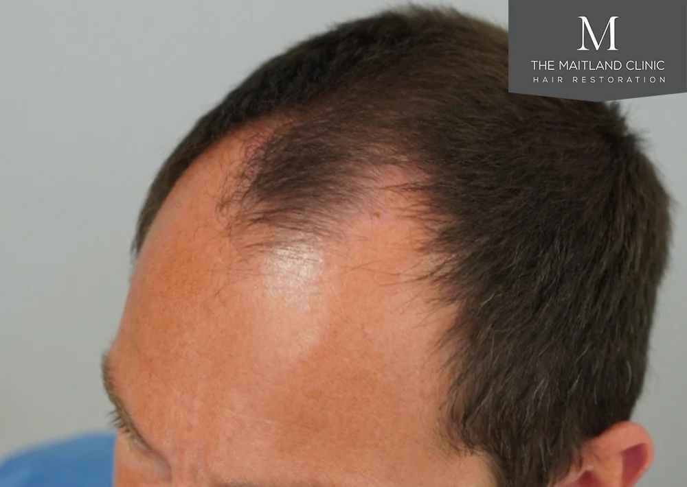 Before hair restoration: Male patient underwent FUE procedure of 1675 grafts.