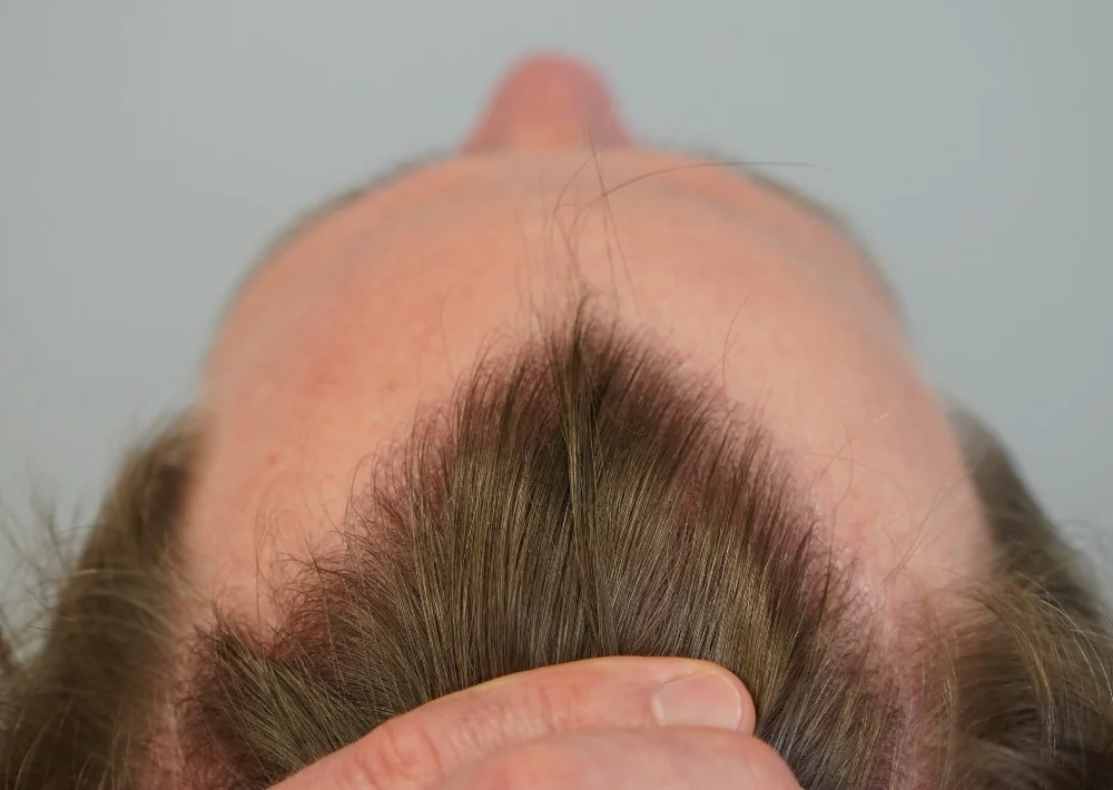 After hair restoration: Male patient underwent FUE procedure of 1222 grafts.