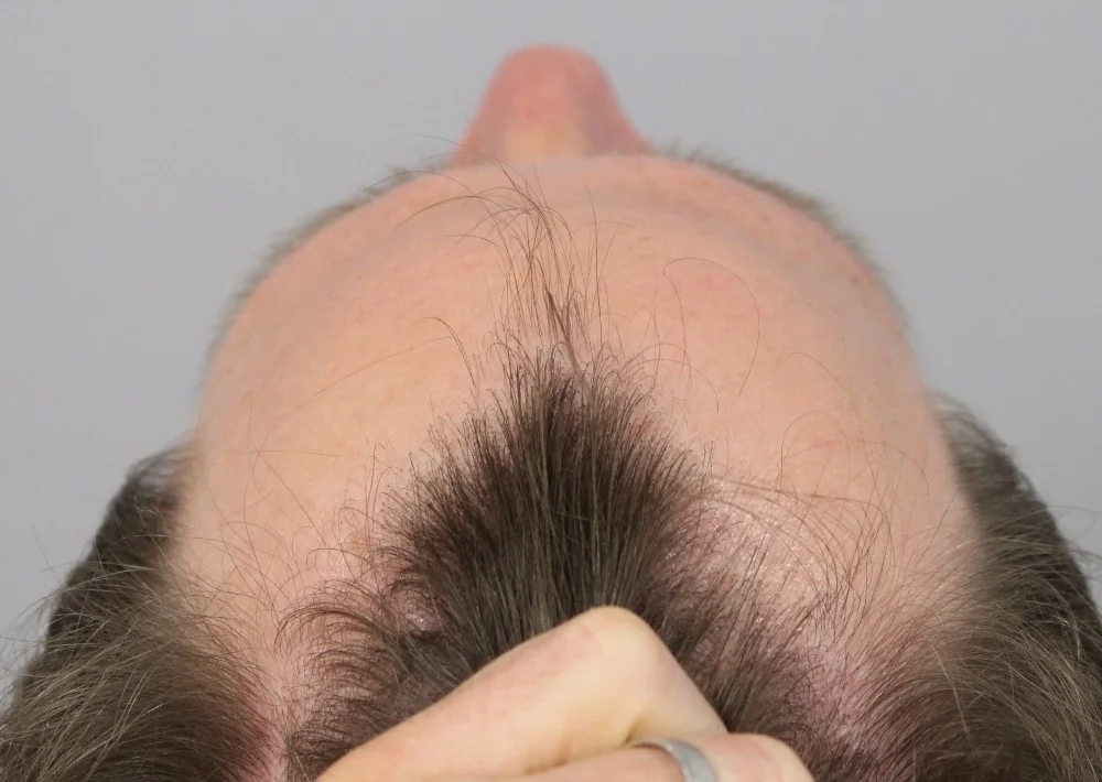Before hair restoration: Male patient underwent FUE procedure of 1222 grafts.