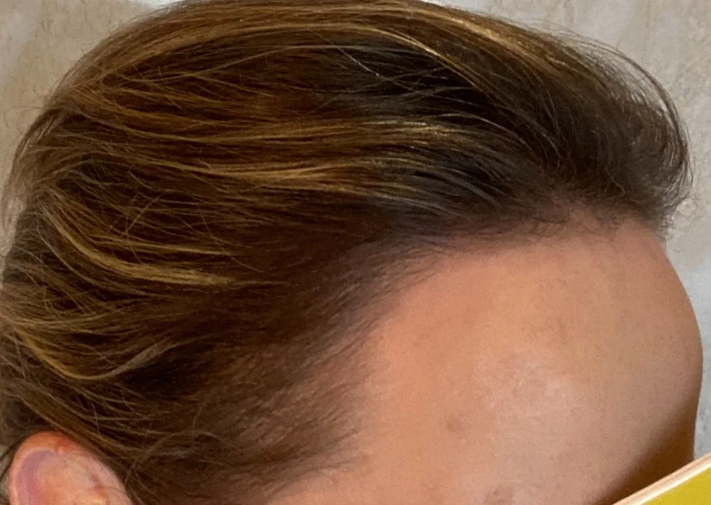After hair restoration: Female patient underwent FUT procedure of 1409 grafts.