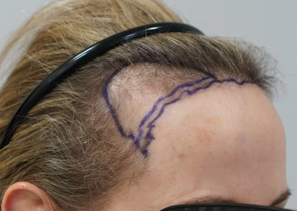 Before hair restoration: Female patient underwent FUT procedure of 1409 grafts.