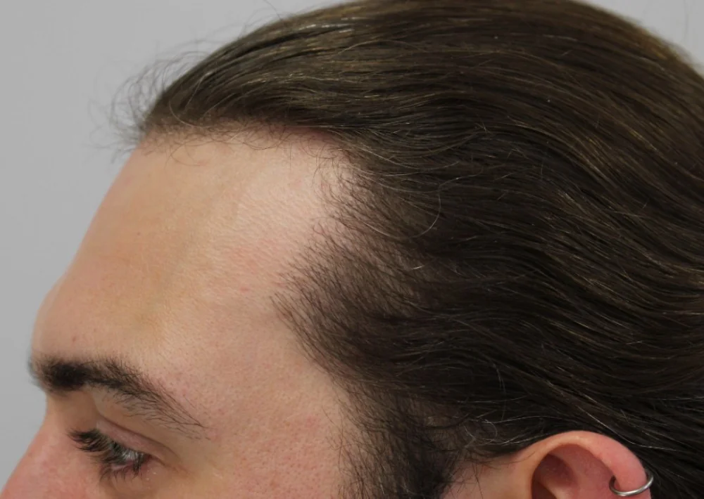 After hair restoration: Male patient underwent FUE procedure of 153 grafts.