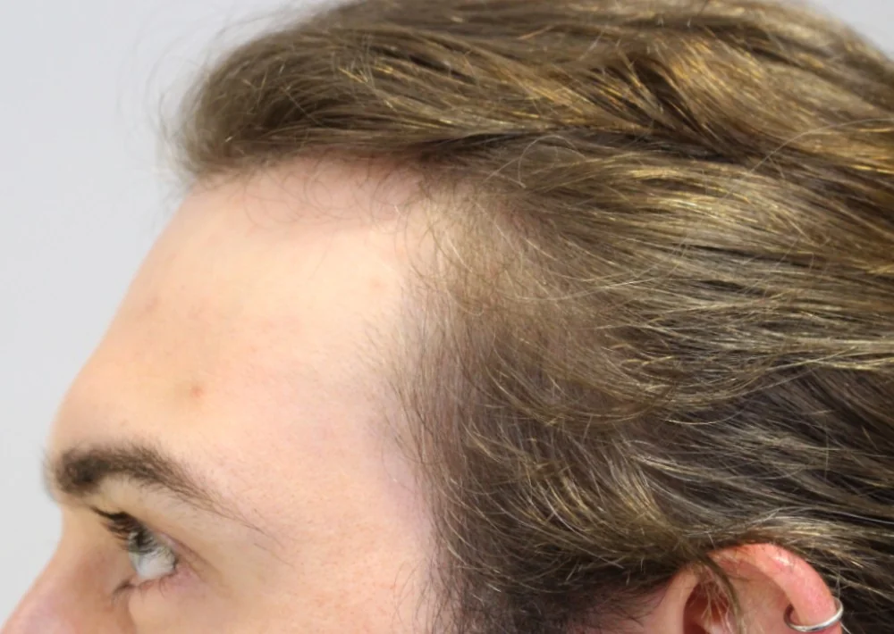 Before hair restoration: Male patient underwent FUE procedure of 153 grafts.