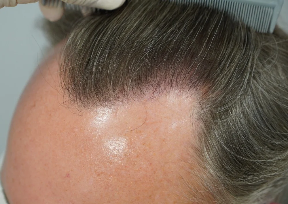 After hair restoration: Male patient underwent FUE procedure of 1175 grafts.